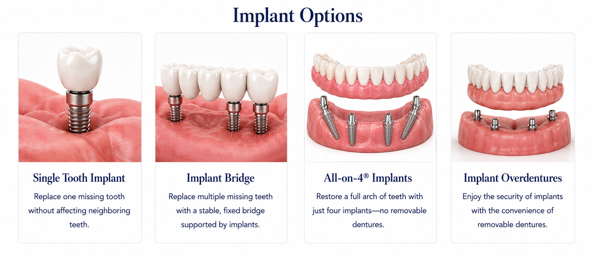 Implant Options — Single Tooth, Bridge, All-on-4, Overdentures