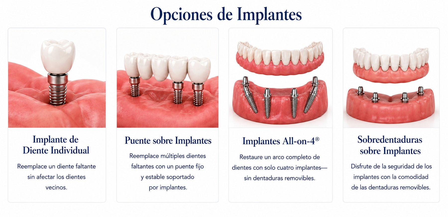 Opciones de Implantes — Single Tooth, Bridge, All-on-4, Overdentures