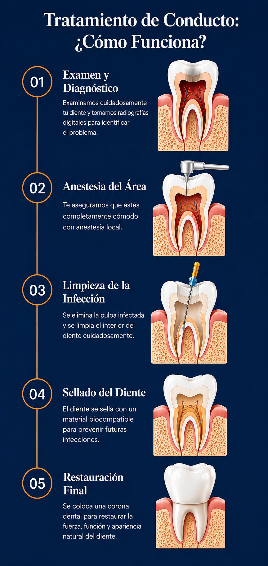 Pasos del conducto radicular