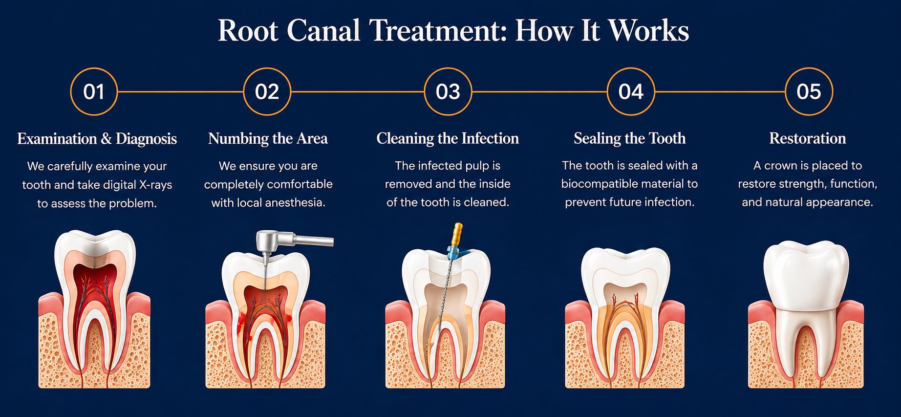 Step by step root canal process